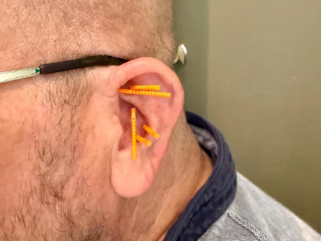 Side view of an ear with five NADA protocol needles placed