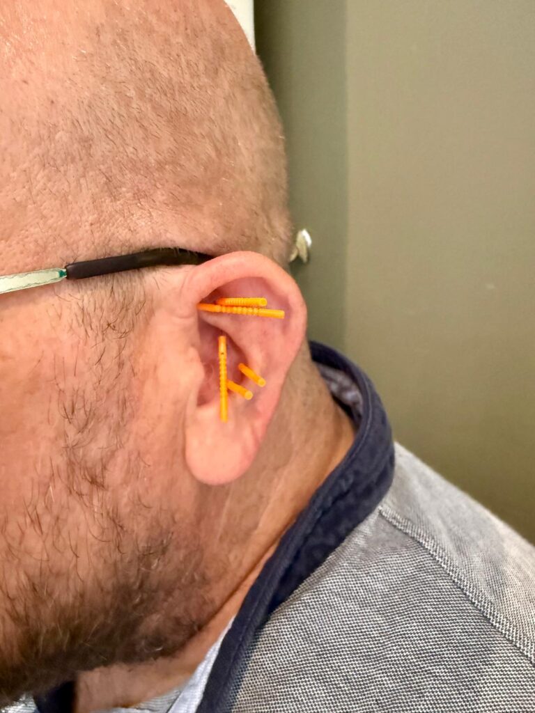 Close-up of an ear with NADA needles in place